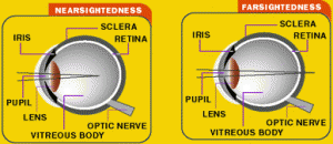 Refractive Errors of the Eyes